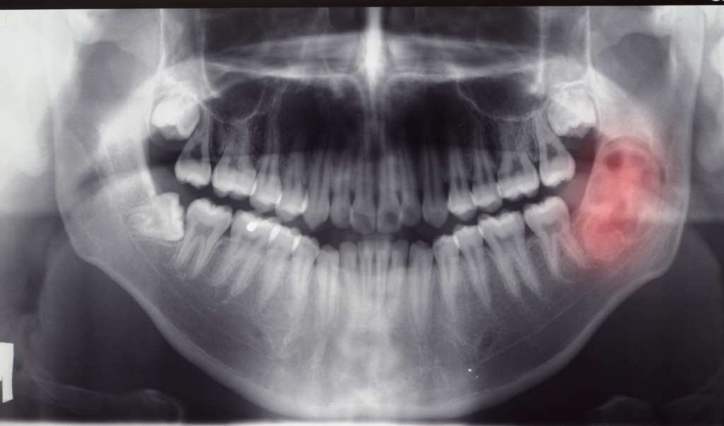 dental xray image with red spot